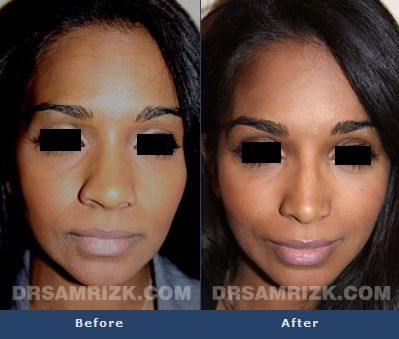 Before and after photo of a 25 year old female patient who had a rhinoplasty. Nostril Reduction Before And After, Ethnic Nose Job, Nostril Reduction, Ethnic Rhinoplasty, Cosmetic Aesthetic, Body Surgery, Nose Jobs, Rhinoplasty Nose Jobs, Nasal Septum