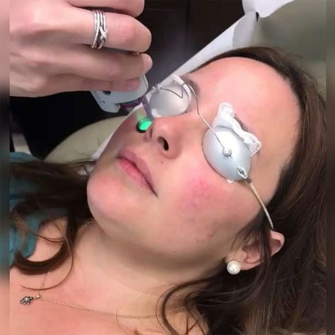 Skin care is one of the most important aspects of preserving one’s appearance.  🥰🥰🥰 #wbo #womensbeautyoffers #beautybllogers #beautyfashion #fashion #fractional #restoringskin #skin #sharplight Profractional Laser, Erbium Laser, Face Laser, Acne Scaring, Acne Laser, Face Treatments, Laser Skin Resurfacing, Fractional Laser, Laser Resurfacing