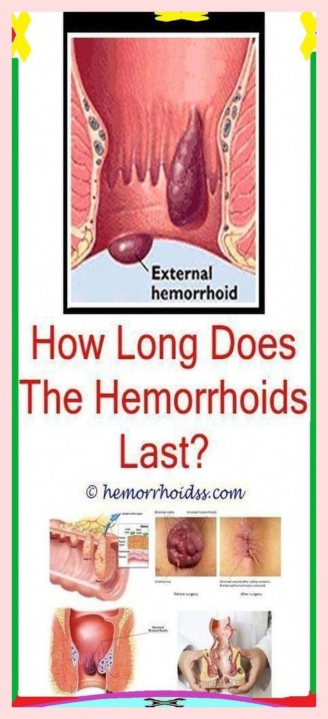 Fastest Removal of Hemorrhoids With These Natural Remedies ! What Causes Warts, Thrombosed Hemorrhoid, Lump Behind Ear, Warts On Hands, Warts On Face, Skin Bumps, Get Rid Of Warts, Lose 40 Pounds, Irritated Skin