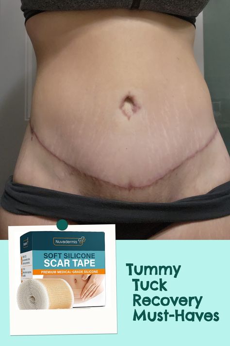 Ready to bounce back after your tummy tuck?👩‍👩‍👧‍👦 Discover the top recovery essentials you absolutely need to make the process more comfortable and stress-free. Check out our comprehensive list now!🎁 Plus Size Tummy Tucks Before And After, Tummy Tucks Recovery List, Tummy Tucks Recovery Tips, Mommy Makeover Recovery, Mommy Makeover Surgery Recovery, Tummy Tucks Recovery, Mommy Makeover Surgery, Amazon List, Mommy Makeover