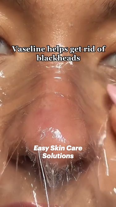 Easy Skin Care Solutions to Remove Unwanted Blackheads Easy Skin Care, Back Acne Remedies, Blind Pimple, Acne Overnight, Cold Sores Remedies, Natural Sleep Remedies, Perfect Skin Care Routine, Get Rid Of Blackheads, Natural Cough Remedies