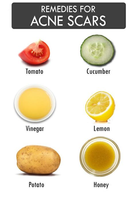 Remedies For Acne, Acne Overnight, Acne Face, Face Home, Natural Acne Remedies, Natural Acne, Home Remedies For Acne, Acne Scar Removal, Face Products