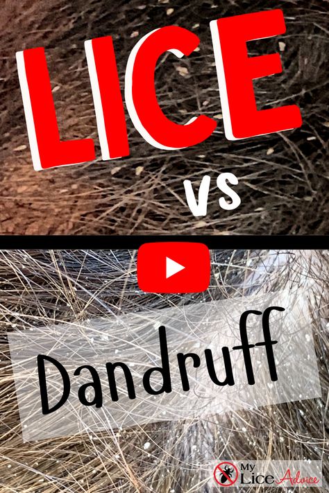 Lice eggs and dandruff are easily mistaken for one another. In this video tutorial, look at side-by-side pictures and videos, and you can easily see the difference between lice and dandruff. Both lice and dandruff can leave your head itching, so how are you supposed to know which is which? This foolproof guide, loaded with side-by-side pictures, will show you exactly how to tell the difference between lice and dandruff. #myliceadvice #licevsdandruff #lice Lice Remedies How To Get Rid Of Home, How To Get Rid Of Lice And Nits Fast, Lice Removal Videos, Dandruff In Kids, Lice In Hair, Lice Pictures, Itchy Scalp Remedy, Lice Nits, Lice Remedies