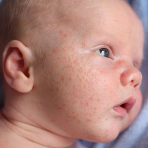 Infant Acne Baby With Freckles, Newborn Acne, Baby Heat Rash, Rash On Face, Baby Acne, Prickly Heat, Heat Rash, Baby Baden, Baby Driver