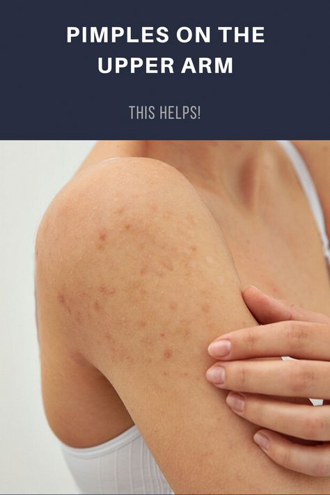 Where did they come from? Pimples on the upper arm may not be a disaster, but they're not welcome either. You can get rid of them that way! Acne On Arms, Remove Skin Tags Naturally, Blind Pimple, Natural Remedies For Cough, Forehead Acne, Pimples Under The Skin, Back Acne, Get Rid Of Pimples, Prevent Pimples