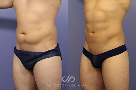 Liposuction for Men Before and After Pictures Case 986 | Los Angeles, CA | Stoker Plastic Surgery Lipo Hd, Before After Body, Six Pack Men, Top Surgery, Patrick Bateman, Mommy Makeover, Body Modification, Personal Aesthetic, Breast Augmentation