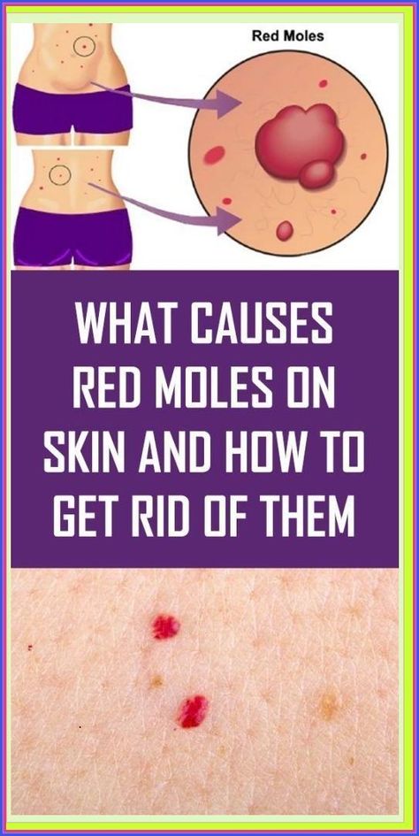 What Do The Red Moles On The Body Mean? Red Moles On Skin, Red Moles, Types Of Red, Health Planner, Medical Practice, Blood Vessels, Health Remedies, Mole, Hair Removal