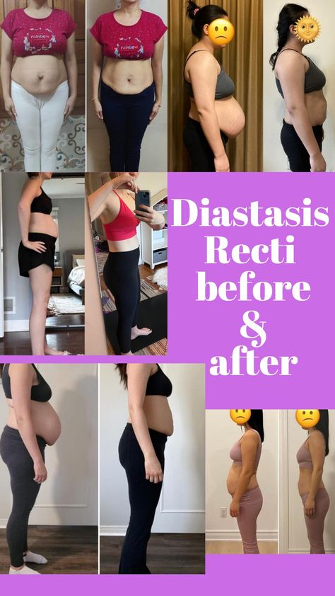 Diastis Recti Before And After, Diastasis Recti Surgery Before And After, Postpartum Before And After, Diastasis Recti Before After, Diastasis Recti Repair, What Is Diastasis Recti, Before And After Transformation, Transformation Pictures, Postpartum Fitness