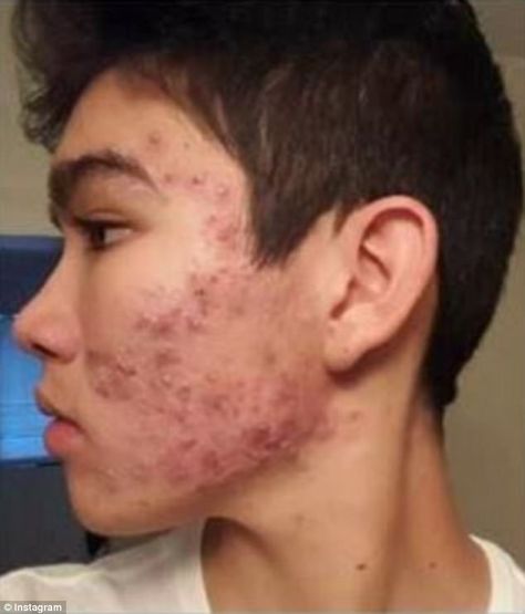 Teenage boy CLEARED severe acne with an $8 moisturizer Budget Skincare, Acne Men, Comedonal Acne, Teenage Acne, Remedies For Acne, Acne Moisturizer, Bad Acne, Best Acne Products, Acne Help