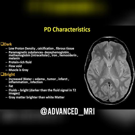 Advanced_MRI / MRI Innovation on Instagram: “MRI daily lesson @advanced_mri_  #mri#advanced_mri #science#mritech #radiology #mridaily #hospital #medicalimaging #hightech #magnetic…” Mri Physics, Mri Study Guide, Medical Radiography, Mri Tech, Radiology Imaging, Medical Animation, Radiology Technologist, White Matter, Mri Scan