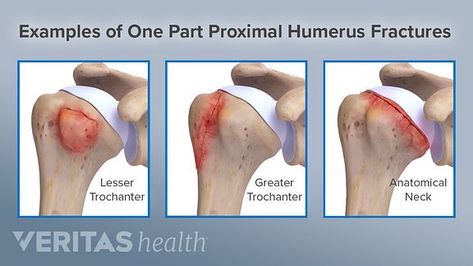 Proximal humerus fractures are a common type of shoulder fracture that can cause pain, swelling, and of the arm. Humerus Fracture, Types Of Fractures, Shoulder Dislocation, Arm Bones, Bone Fracture, Medical Student Study, Muscle Contraction, Shoulder Injuries, Bone Density