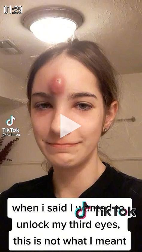 Big pimple blackhead Closed Comedones, Skin Blackheads, Big Pimple, Look Jean, Types Of Acne, Going Out Hairstyles, Quince Hairstyles, Get Rid Of Blackheads, Homecoming Makeup Browneyes