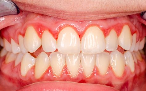 Bleeding gums when you brush? It's not normal! Your body's trying to tell you something about inflammation. Learn what to do about it – check out our new blog post!

https://www.midwestbiohealth.com/midwestbiohealth-holisticliving-blog/from-bleeding-gums-to-better-health-4-steps-to-stop-inflammation Tartar Teeth, Holistic Dentistry, Gum Inflammation, Sedation Dentistry, Gum Health, Healthy Smile, Good Mental Health, Alternative Health, Oral Hygiene