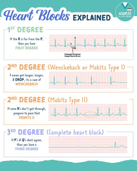 A heart block of any degree is a... - Nurse In The Making Heart Blocks Made Easy Nursing, Cardiac Monitor Tech, Heart Blocks Nursing, Ekg Interpretation Made Easy, Ekg Nursing, Nurse In The Making, Ekg Interpretation, Nurse Teaching, Pr Interval