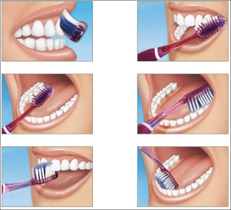 Brushing Technique, Dental Posts, Remedies For Tooth Ache, Dental Posters, Tooth Brushing, Kedokteran Gigi, Sikat Gigi, Dentist Humor, Dental Life