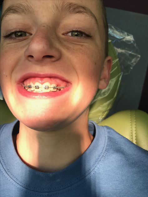 Jacob at the orthodontist getting his bottom braces put on Bottom Braces, Braces, Put On, Septum Ring, Nose Ring, Pins, Quick Saves