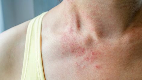 Dust Mites Bites, Keto Rash, Common Skin Rashes, Shingles Rash, Rash On Neck, Itchy Rash, Heat Rash, Allergy Symptoms, Skin Disorders