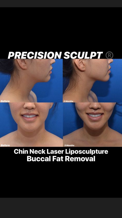 Facial sculpting in an Asian patient with a combination of PRECISION SCULPT®️ laser liposculpture of the chin and neck and buccal fat removal. This procedure redefines the lower face and neck to improve contouring, decrease lower face fullness, sharpens the jawline, and generally produces a slimming effect. This procedure is performed comfortably in the office under local anesthesia. Do it on a Friday and back to work on Monday. Laser Fat Removal, Buccal Fat Removal, Facial Sculpting, Botox Facial, Local Anesthesia, Facial Fillers, Fat Transfer, Excess Skin, Nose Job