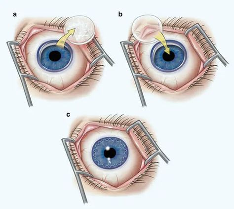 The cornea transplant procedure at Bharti Eye Foundation offers a ray of hope for individuals suffering from corneal disorders. Highly skilled ophthalmologists perform the surgery, ensuring the utmost precision and care. With state-of-the-art technology and a patient-centric approach, Bharti Eye Foundation has gained recognition for its excellence in cornea transplant surgeries. Retina Surgery, Corneal Transplant, Eye Specialist, Social Media Ideas, Ray Of Hope, Eye Hospital, Eye Surgery, Delhi India, Art And Technology