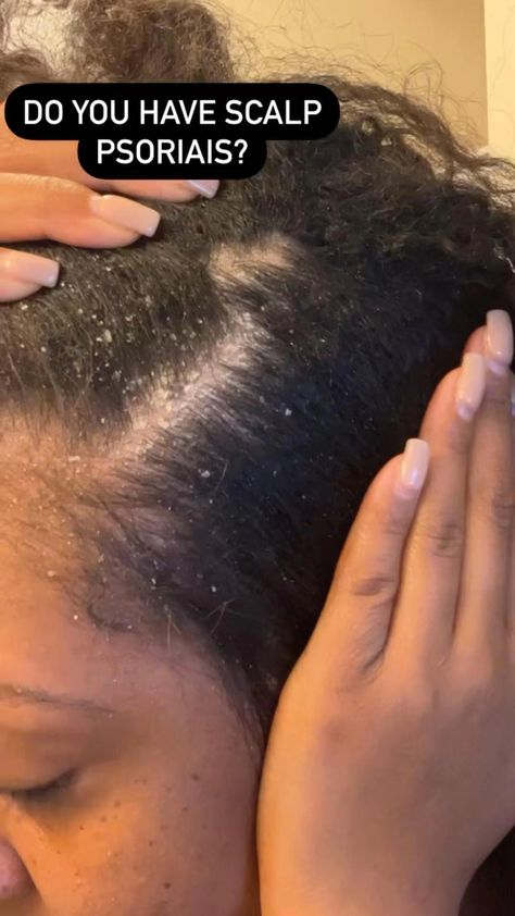 #NaturalHairLoss Stiff Hair Remedies, Dandruff Remedy Severe Black Hair, Seborrheic Dermitis On Scalp, 4c Natural Hair Care, Dandruff Removal, Hair Chart, Natural Hair Remedies, Rid Of Dandruff, Kitchen Cabinet Inspiration