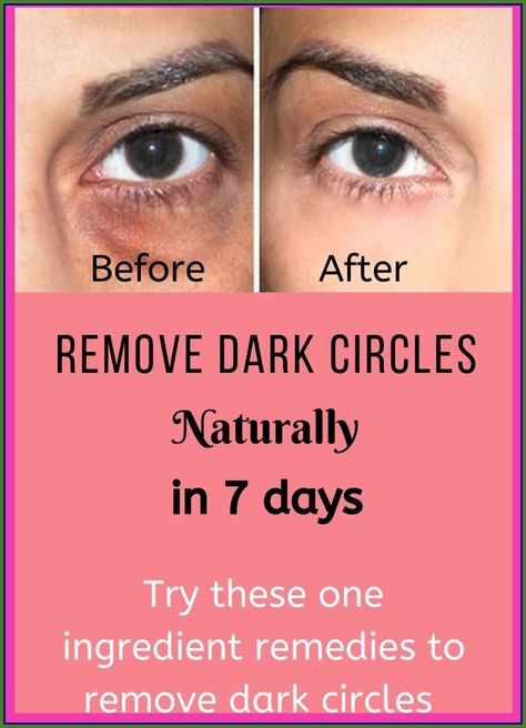 REMOVE DARK CIRCLES UNDER EYES IN 7 DAYS !!! Remove Dark Circles, Under Eyes, Dark Circles Under Eyes, Creating A Newsletter, Years Younger, Health And Fitness Tips, Dry Brushing, Health Remedies, Dark Circles