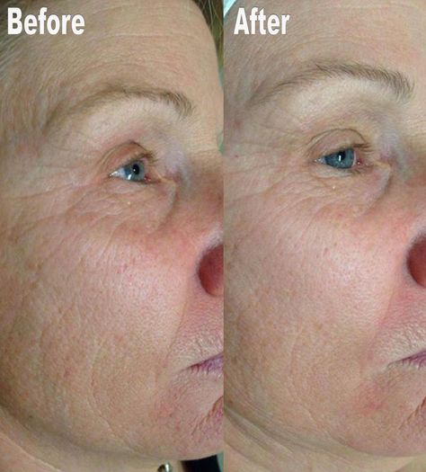 A picture speaks a thousand words this before and after shows you the power of Dermaviduals and Collagen Induction Therapy. Picture Speaks A Thousand Words, Botox Before And After, Makeup Before And After, Real Skin, Hair Removal Permanent, After Workout, Tattoo Removal, Hair Transplant, Spray Tanning