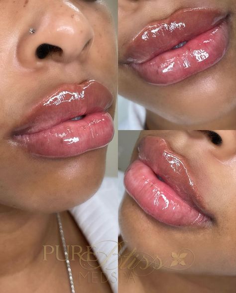 Lip Injections Black Women, Getting Lip Fillers, Lip Injections Before And After Black Women, Bratz Doll Lip Filler, Cosmetic Injectables Aesthetic, Lip Filler Before And After Black Women, Lip Injections Aesthetic, Lip Inspo Filler, Lip Filler Black Women