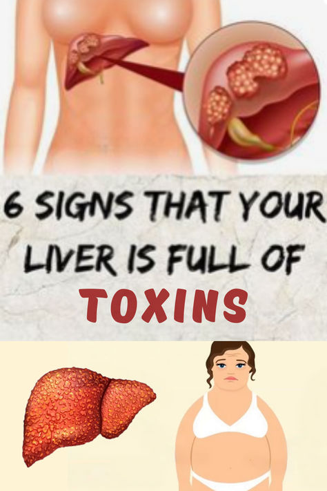 Signs that the liver may be overworked include persistent fatigue, abdominal bloating, pale stools, and yellowing of the skin and eyes. #overworkedliver #liver #liverhealth #healthyliver Overworked Liver, Liver Care, Liver Issues, Homemade Detox Drinks, Sausage Soup, Healthy Blood Sugar Levels, Workout Without Gym, Healthy Liver, The Liver