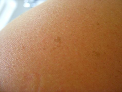 Heart shaped freckle- i want A tattoo to look like this Heart Shaped Freckles, Heart Shaped Birthmark, Heart Birthmark, Heart Freckle Tattoo, I Want A Tattoo, Freckle Tattoo, J Tattoo, Subtle Tattoos, Body Mods