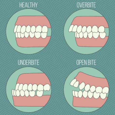 Normal teeth do not mean the upper teeth being parallel to the lower, instead the upper teeth come over the lower a little bit, like 1-2mm, both horizontally and vertically, which is called normal overbite or overjet. Only in this case, the function and aesthetics of the teeth can be guaranteed. Orthodontics Marketing, Dental Assistant Study, Orthognathic Surgery, Dental Check Up, Kedokteran Gigi, Dental Hygiene School, Dental Anatomy, Dental Fun, Dental Facts