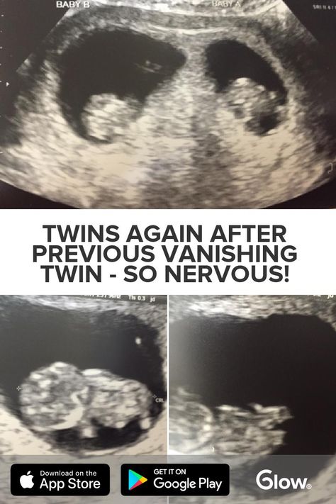 Twins AGAIN after Previous Vanishing Twin - so nervous! - Hi all! Excited and nervous to be here!! In 2013 we found out we were expecting twins at 6 weeks,... - See the rest of this post by downloading Glow Nurture - The Top Rated Pregnancy Vanishing Twin Syndrome, Vanishing Twin, Ultrasound Gender, First Ultrasound, Over Analyzing, Expecting Twins, Were Expecting, Twin Pregnancy, Just Pray