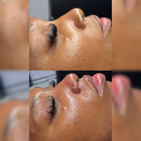 Before and after a Dermaplane facial ☁️☁️ Dermaplane Facial, Facial Before And After, Facial, Quick Saves