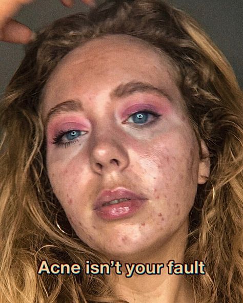 Acne positivity skin positvity @spottylittlething Acne Representation, Acne Positivity Quotes, Acne Is Beautiful, Acne Positive, Strawberry Freckles, Acne Aesthetic, Acne Photos, Acne Awareness, Acne Positivity