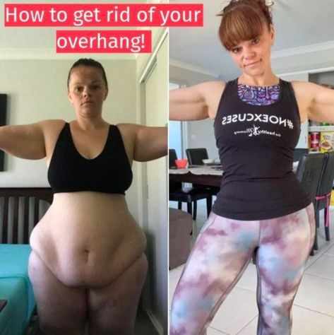 You don’t have to do endless crunches to get rid of your tummy overhang! Belinda is PROOF. How To Shrink Hanging Belly, How To Get Rid Of Belly Overhang, Belly Overhang Get Rid Of, Overhang Belly Exercise, Apron Exercises, Apron Stomach How To Get Rid, Apron Stomach Workout, Stomach Overhang Exercise, Apron Tummy Workout