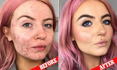 Women are praising this foundation for COMPLETELY covering their acne - and it only costs $18 | Daily Mail Online Acne With Makeup, Makeup For Acne, Spotty Face, Acne Coverage, Acne Concealer, Covering Acne, Acne Makeup, Acne Problem, Cystic Acne