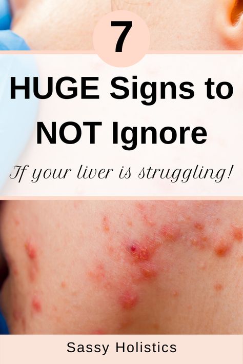 Acne is one of the BIGGEST signs that you need to love your liver more. The skin is a reflection of the liver! Adrenal Fatigue Recovery, Heal Liver, Liver Issues, Kidney Detox, Liver Detoxification, Liver Support, Skin Detox, Gluten Sensitivity, Liver Detox