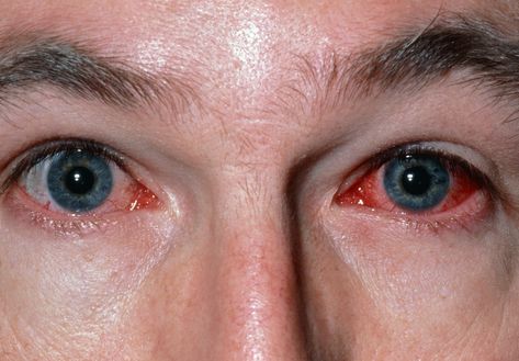 Viral Conjunctivitis - Etiology, pathophysiology, symptoms, signs, diagnosis & prognosis from the Merck Manuals - Medical Professional Version. Weird Things People Do, Eye Disorders, Eye Diseases, Eye Infections, Dark Underarms, High Fever, Pink Eye, Eyes Problems, Sinus Infection