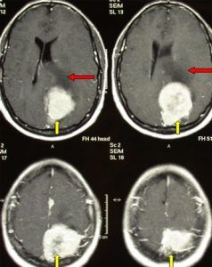 Benign Brain Tumors - Non-Cancerous Tumor - Brain-Surgery.com Brain Tumour Ct Scan, Brain Radiology, Brain Surgery Recovery, Mri Brain, Computed Tomography, Brain Tumour, Brain Tumors, Brain Images, Brain Anatomy