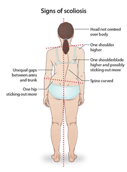 Uneven Shoulders, Skeleton Muscles, Pilates Teacher Training, Physical Therapy School, Spine Problems, Physical Therapy Assistant, Massage Therapy Techniques, Basic Anatomy And Physiology, Lower Back Pain Exercises