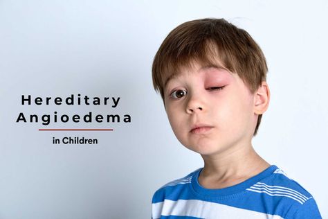 Swelling of body parts is a common phenomenon we all experience in various instances in regular life. Sometimes, this inflammation may not be an innocent swelling but something more serious like hereditary angioedema in children.
A rare genetic disorder that can cause unnecessary and unexpected swelling in your child can be quite alarming. Does your child have hereditary angioedema?  Here is all you need to know about this genetic condition. Rare Genetic Disorders, Positive Parenting, Genetic, Baby Care, Need To Know, Conditioner, Parenting, Things To Come, Reading