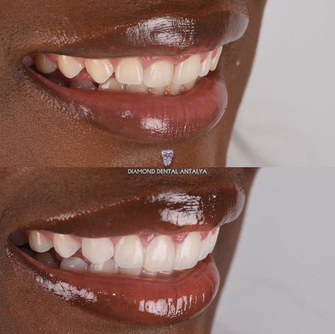 She said, “I am very picky”! - 6 Composite Bonding Our patient Elett from England came to us with concerns about her small tooth size and crowding. She had high aesthetic expectations, letting us know she was hard to please. To address her needs, we first recommended and performed gingivectomy (gum contouring) to reveal more of her natural teeth. Together with Elett, we confirmed the new tooth proportions were just right! After allowing three days for her gums to heal, we proceeded with com... Teeth Fillings Before And After, Teeth Bonding Before And After, Composite Bonding Teeth, Gum Contouring, 2025 Intentions, Teeth Bonding, Composite Bonding, Teeth Aesthetic, High Aesthetic