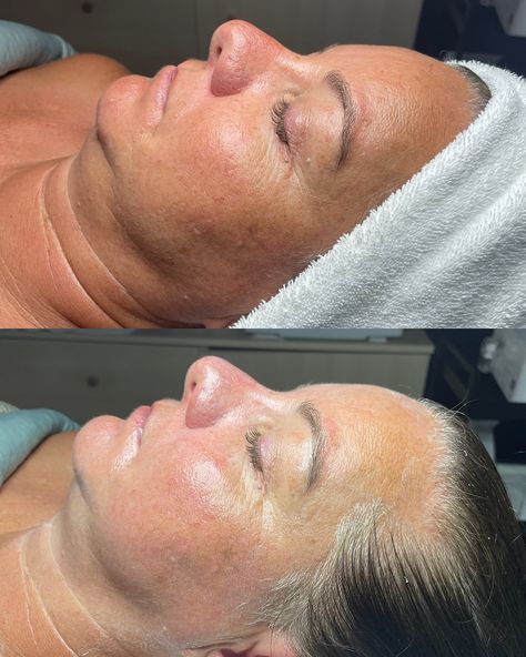 it’s officially chemical peel season! 🍌 chemical peels are great for those wanting to work on pigment, acne scarring, fine lines, and overall appearance. it’s best to do these peels in the fall/winter months when we are not out in the sun as much (aka now!) swipe to see a before and after of a peel🍌 you know you want one ☺️ #spookyseason👻 #fall #thespakearney #kearneynebraska #facial #thespaestheticsandmassage #kearney #estheticianlife #esthetics #facials #esthetician #facialskincare #fa... Chemical Peel Season, Chemical Peel Before And After, Peel Season, Vi Peel, Kearney Nebraska, Acne Scarring, Chemical Peels, Scarring, Chemical Peel