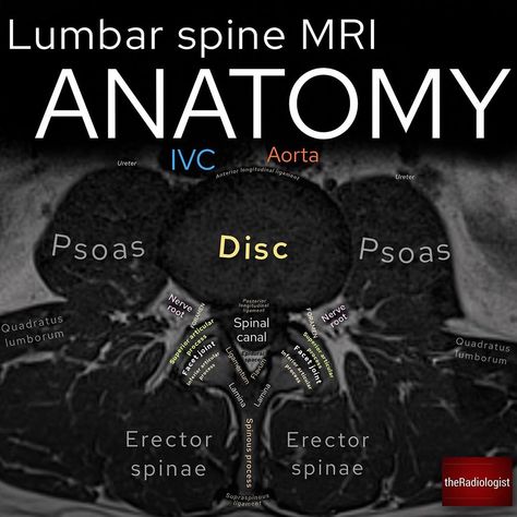 AXIAL LUMBAR SPINE MRI ANATOMY⁣ ⁣ 👨🏽‍💻Here we have an axial slice of the lumbar spine with T1 weighting - notice how the fluid in the… Lumbar Mri Anatomy, Mri Study Guide, Mri Anatomy, Medical Radiography, Mri Brain, Radiology Student, Radiology Imaging, Anatomy Bones, Interventional Radiology