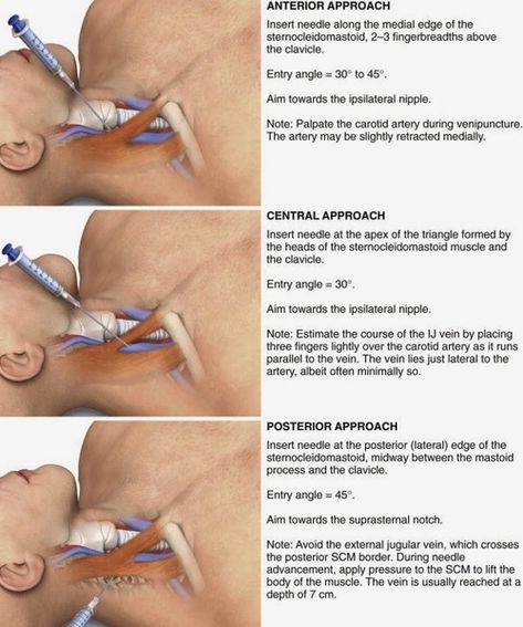 Approach to the Internal Jugular Vein.  Click image to enlarge. Central Line Catheter, Doctor Knowledge, Picc Nurse, Jugular Vein, Emt Study, Heart Arteries, Medical Terminology Study, Central Line, Basic Anatomy And Physiology