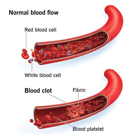 Leg Discoloration, Disseminated Intravascular Coagulation, D Dimer, Blood Test Results, Loss Of Balance, Feeling Dizzy, Hormone Replacement, Emergency Room, Blood Test