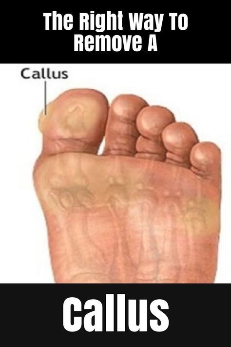 The Right Way To Remove A Callus Callus Remover Diy, Best Callus Remover, Callous Remover, Nail Problems, Tongue Health, Callus Remover, Natural Cough Remedies, Callus Removal, Body Detox