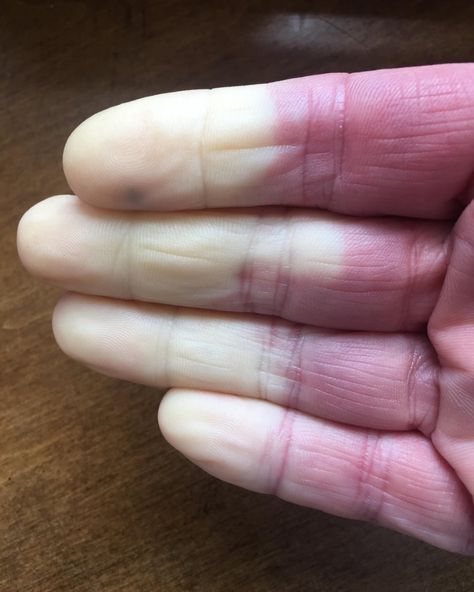 This is Raynaud’s Phenomenon. When exposed to cold or even cool air; blood stops flowing to the fingers due to vasospasm. It’s often accompanied by changes in the color of the skin. Experiences can be numbness, pain, or the feeling of pins and needles. Symptoms of Raynaud’s can last from a few minutes to several hours. It’s not a serious threat to your health, but can sometimes be painful or difficult to live with. Since It can affect your ability to move your fingers and hands. Raynauds Phenomenon, Pins And Needles, Blood Circulation, Disease, Turning, Turn Ons, Feelings, Canning, Skin