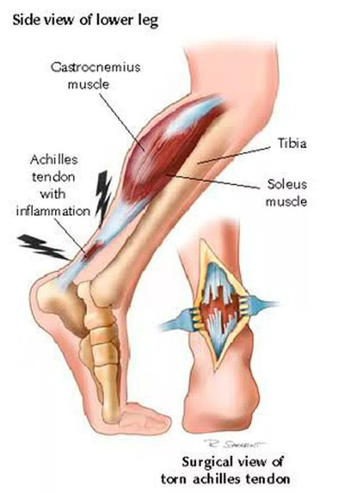 Achilles tendon rupture - MEDizzy Strength Exercises For Runners, Achilles Tendon Ruptures, Pregnancy Remedies, Lower Back Pain Remedies, Lower Back Pain Causes, Muscle Inflammation, Pregnancy Back Pain, Obese Workout, Hip Strengthening Exercises