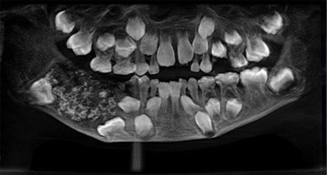 Child had 500 extra teeth extracted and he's going to be fine  ||  Child had 500 extra teeth extracted and he's going to be fine https://boingboing.net/2019/08/01/child-had-500-extra-teeth-extr.html?utm_source=feedburner&utm_medium=feed&utm_campaign=Feed%3A+boingboing%2FiBag+%28Boing+Boing%29 Extra Teeth, General Anaesthesia, Jaw Pain, Indian Boy, The Teeth, Dental Health, Oral Health, Apple Products, Chennai