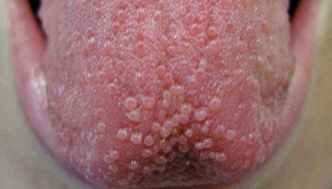 Tongue Bumps: How to Get Rid of Them Lie Bumps On Tongue, Blister On Tongue, Bumps On Tongue, Ulcer On Tongue, Tongue Sores, Homemade Mouthwash, Tongue Health, Nail Care Tips, Nail Health